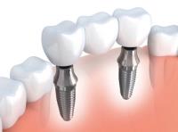 Dental Implants image 4